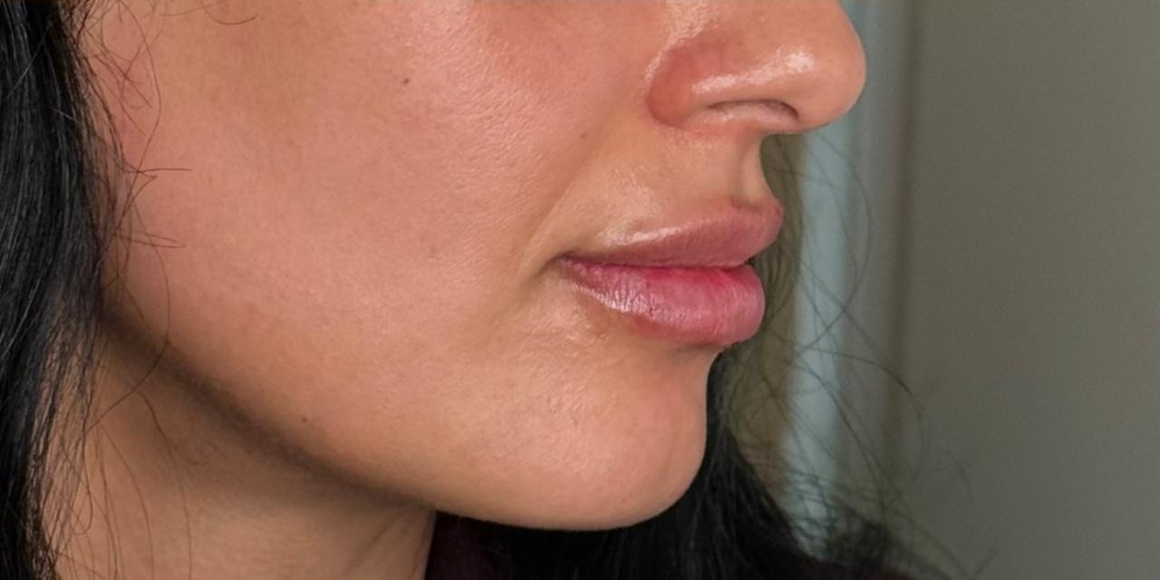 After treatment